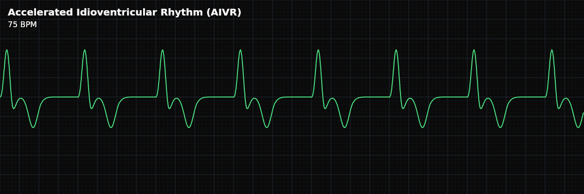 Accelerated Idioventricular Rhythm (AIVR) EKG rhythm strip showing A wide-complex ventricular rhythm at 50-100 BPM — faster than ventricular escape but slower than VT. Usually transient, benign, and classically associated with myocardial reperfusion.