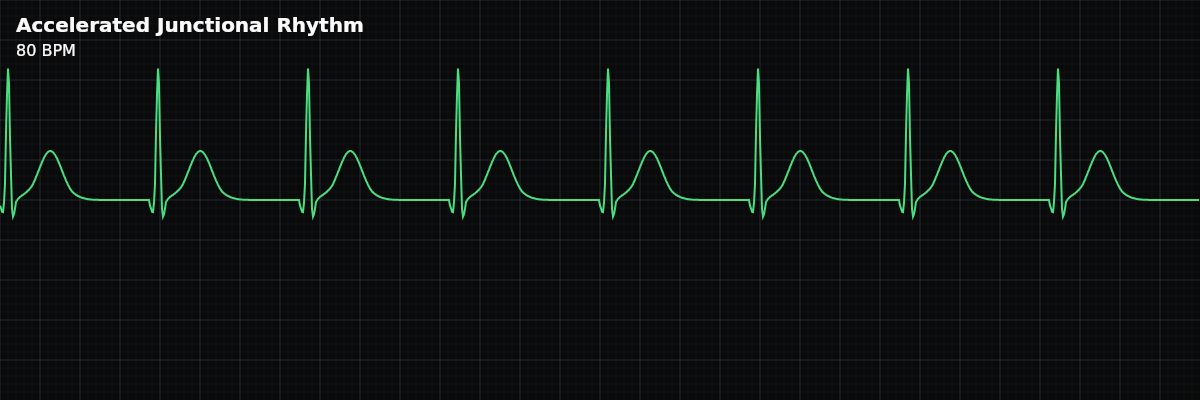 Accelerated Junctional Rhythm EKG rhythm strip showing A junctional rhythm with enhanced automaticity at 60-100 BPM — faster than the inherent junctional rate but not tachycardic. The junction usurps control from the SA node.