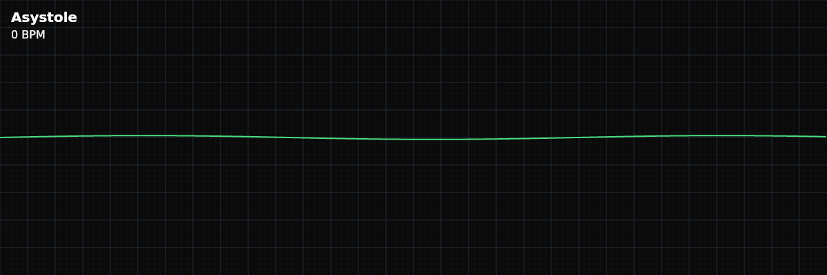 Asystole EKG rhythm strip showing The absence of all electrical activity in the heart. This is cardiac arrest — the heart has stopped generating any organized impulses.