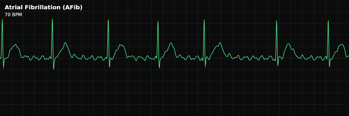 Atrial Fibrillation (AFib) EKG rhythm strip showing The most common sustained arrhythmia worldwide. Characterized by an irregularly irregular rhythm, absence of P-waves, and chaotic fibrillatory baseline activity.
