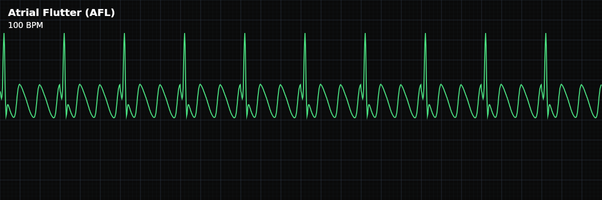 Atrial Flutter (AFL) EKG rhythm strip showing A rapid, organized atrial rhythm driven by a single re-entry circuit in the right atrium, producing sawtooth flutter waves at ~300 BPM with variable AV conduction ratios.