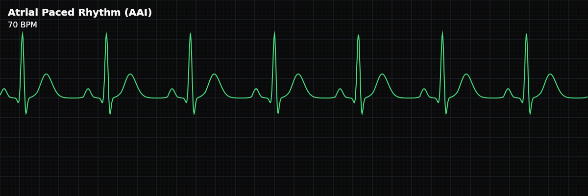 Atrial Paced Rhythm (AAI) EKG rhythm strip showing A pacemaker stimulates the atrium, and the impulse conducts normally through the AV node to produce a narrow QRS. Used when the SA node is dysfunctional but AV conduction is intact.