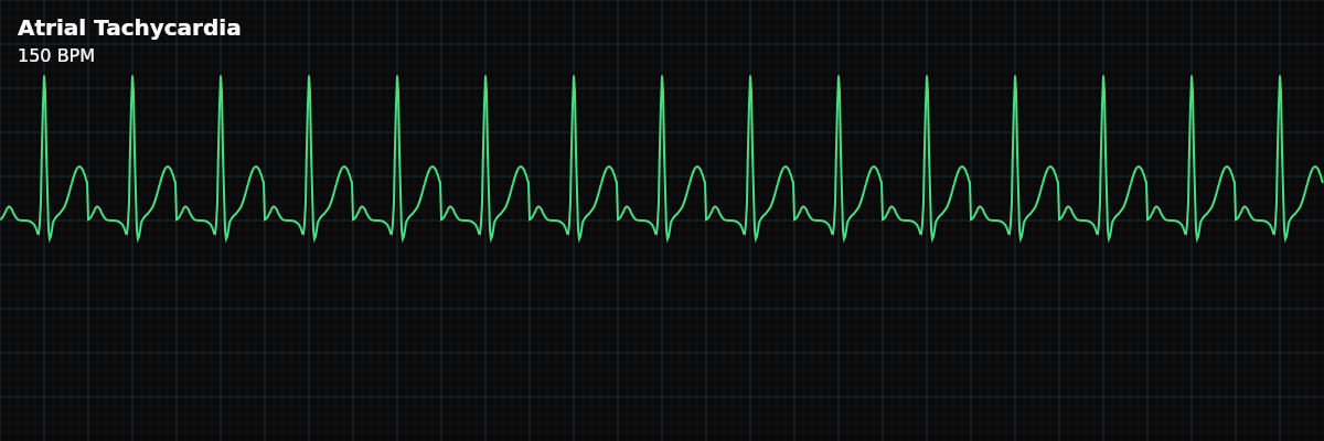 Atrial Tachycardia EKG rhythm strip showing A supraventricular tachycardia originating from an ectopic atrial focus outside the SA node, producing abnormal P waves at rates of 130-250 BPM with the AV node acting as a passive bystander.