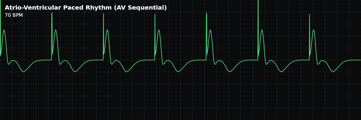 Atrio-Ventricular Paced Rhythm (AV Sequential) EKG rhythm strip showing A rhythm where an artificial pacemaker stimulates both the atria and the ventricles in sequence, maintaining AV synchrony.