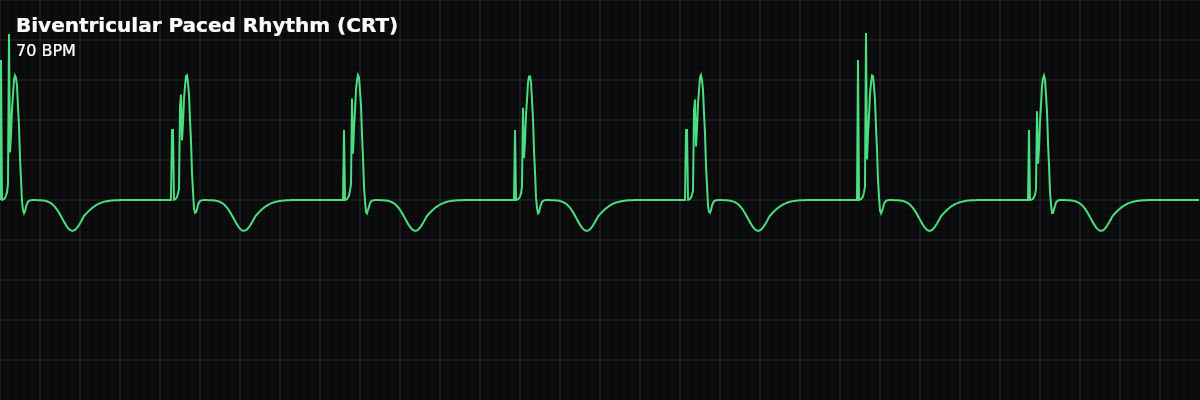 Biventricular Paced Rhythm (CRT) EKG rhythm strip showing Cardiac Resynchronization Therapy paces both ventricles simultaneously to restore synchronized contraction. The QRS has a characteristic notched or M-shaped pattern that is narrower than standard RV-only pacing.