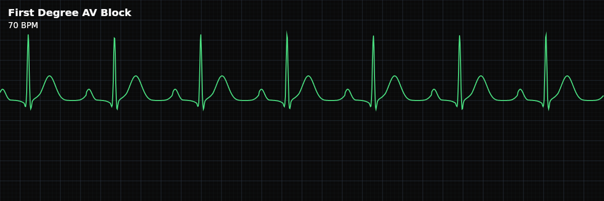 First Degree AV Block EKG rhythm strip showing A conduction delay at the AV node where every P wave is conducted to the ventricles, but the PR interval is prolonged beyond 200ms. Not a true block — more accurately a "first degree AV delay."