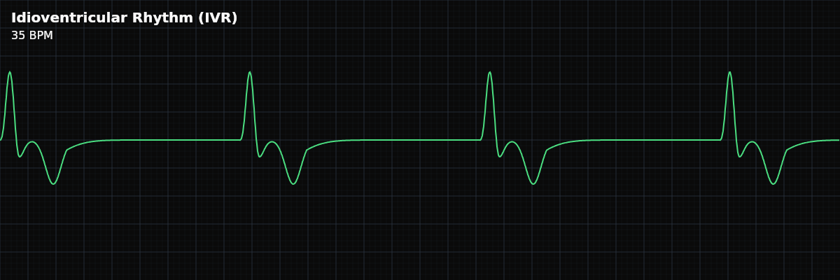 Idioventricular Rhythm (IVR) EKG rhythm strip showing The heart's last-resort escape rhythm — ventricular pacemaker cells fire at their inherent rate of 20-40 BPM when both the SA node and AV junction have failed.