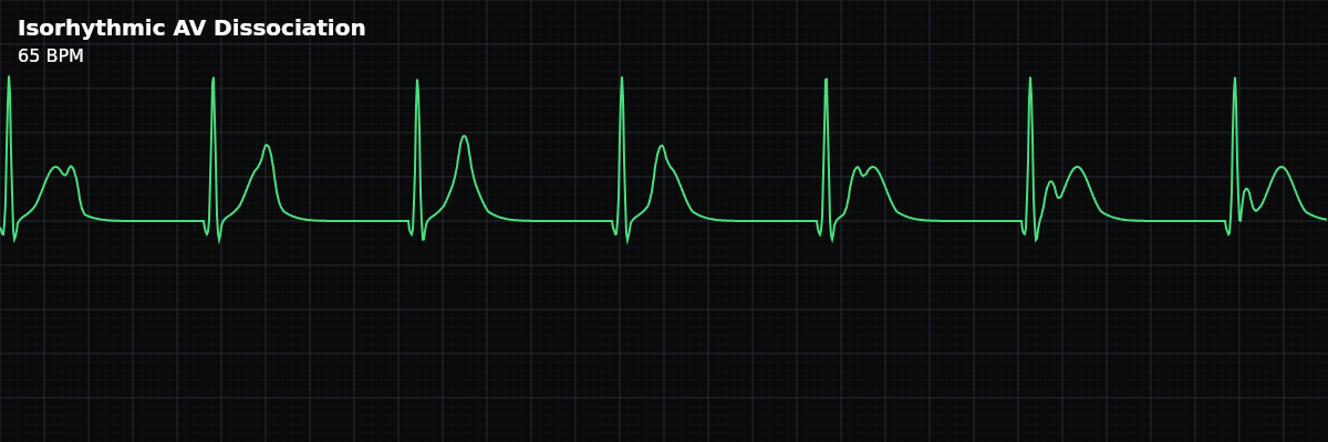 Isorhythmic AV Dissociation EKG rhythm strip showing A benign form of AV dissociation where the sinus node and a junctional pacemaker fire at nearly the same rate. P waves drift slowly relative to QRS complexes, but conduction is intact — this is not a heart block.