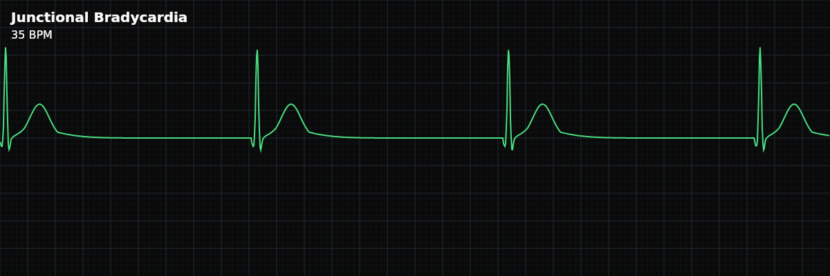 Junctional Bradycardia EKG rhythm strip showing A severely slow junctional rhythm below 40 BPM. It shares junctional P-wave behavior with narrow QRS but carries higher urgency because ventricular rate may be insufficient for perfusion.