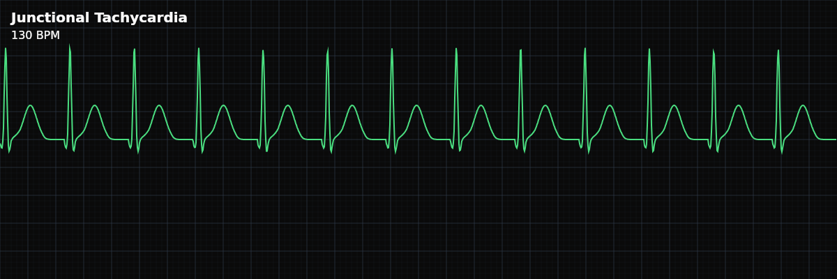 Junctional Tachycardia EKG rhythm strip showing A narrow-complex tachycardia originating from the AV junction at rates exceeding 100 BPM, driven by abnormally enhanced automaticity rather than a re-entry circuit.