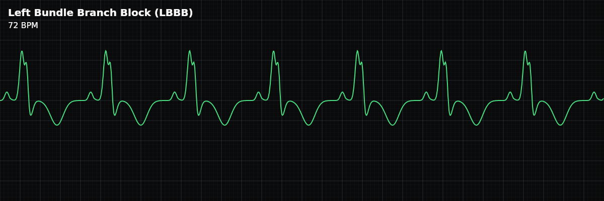 Left Bundle Branch Block (LBBB) EKG rhythm strip showing A conduction abnormality where the left bundle branch is blocked, forcing the left ventricle to depolarize via slow muscle-to-muscle conduction from the right ventricle. The QRS is wide (>= 0.12s, often >= 0.14s) with a QS or rS pattern in V1 and a broad, notched R wave in V6.