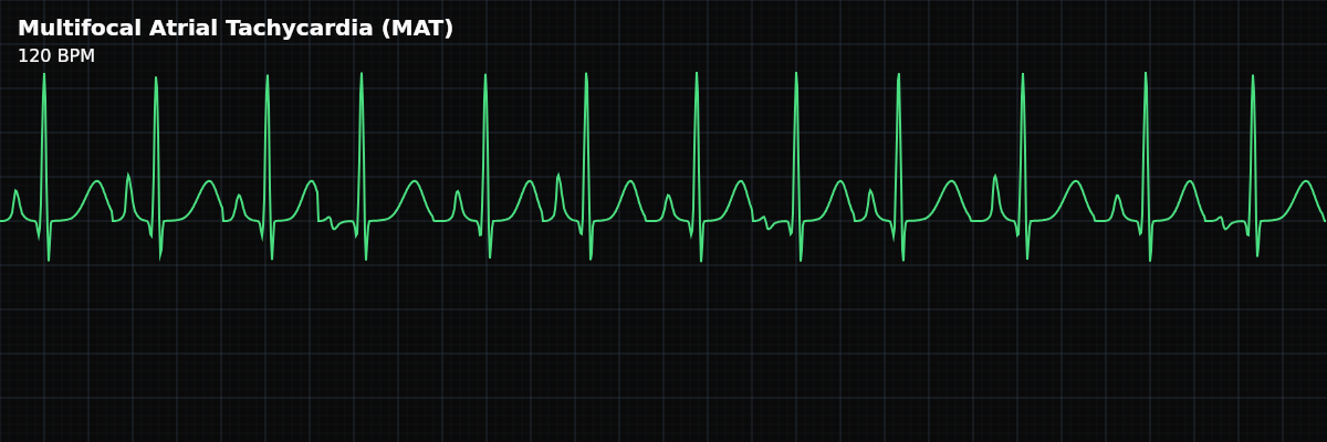 Multifocal Atrial Tachycardia (MAT) EKG rhythm strip showing An irregular atrial tachycardia with at least 3 distinct P-wave morphologies at a rate exceeding 100 BPM, reflecting multiple ectopic atrial foci firing independently.