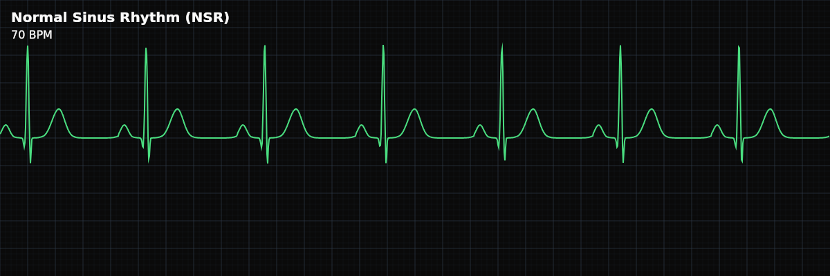 Normal Sinus Rhythm (NSR) EKG rhythm strip showing The baseline rhythm all others are measured against. Master NSR first — every abnormality is a departure from it.