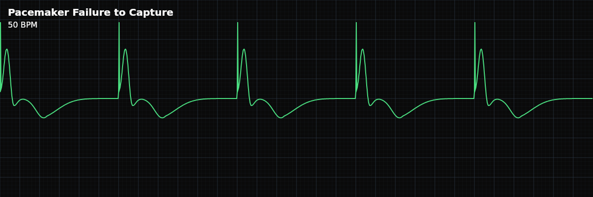 Pacemaker Failure to Capture EKG rhythm strip showing A pacemaker malfunction where the pacing spike fires but fails to produce myocardial depolarization. Spikes are visible on the strip but are not followed by the expected P wave or QRS complex.