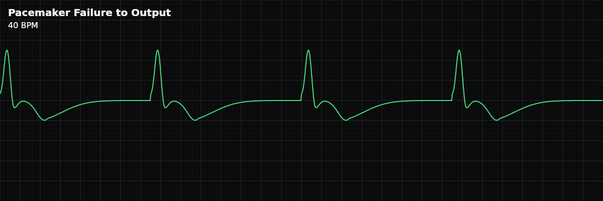 Pacemaker Failure to Output EKG rhythm strip showing A pacemaker malfunction where the device does not fire when expected — the pacing spike itself is absent. The pacemaker is not delivering any stimulus to the heart.