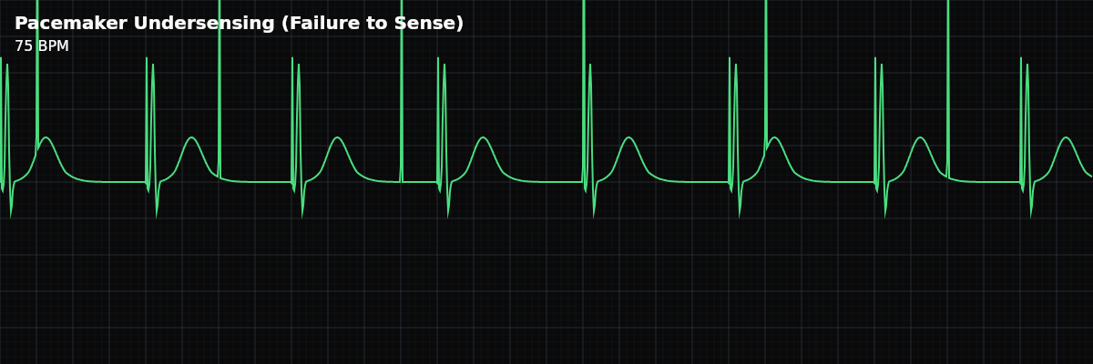 Pacemaker Undersensing (Failure to Sense) EKG rhythm strip showing A pacemaker malfunction where the device does not detect (sense) the heart’s native electrical activity. The pacemaker fires when it should not, delivering pacing spikes into native QRS complexes or T waves because it does not "see" them.
