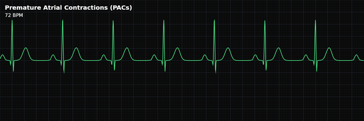 Premature Atrial Contractions (PACs) EKG rhythm strip showing Early beats originating from an ectopic focus in the atria. PACs produce a P wave with abnormal morphology (different shape from sinus P waves) followed by a narrow QRS complex, since conduction through the ventricles follows the normal pathway.
