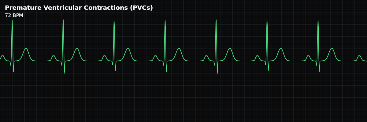 Premature Ventricular Contractions (PVCs) EKG rhythm strip showing Early beats originating from an ectopic focus in the ventricles. PVCs are wide, bizarre-looking QRS complexes that appear before the next expected sinus beat, typically followed by a compensatory pause. They are the most common ventricular ectopy.