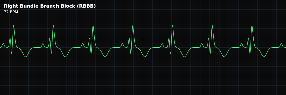 Right Bundle Branch Block (RBBB) EKG rhythm strip showing A conduction abnormality where the right bundle branch is blocked, forcing the right ventricle to depolarize via muscle-to-muscle conduction from the left ventricle. The QRS is wide (>= 0.12s) with a characteristic RSR’ (M-shape) pattern in V1.