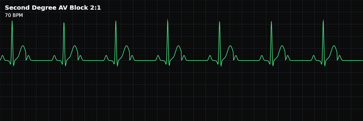 Second Degree AV Block 2:1 EKG rhythm strip showing A fixed 2:1 AV conduction pattern where every other P wave is blocked. Cannot be classified as Type I or Type II from the rhythm alone because no PR pattern is visible.