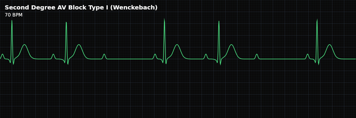 Second Degree AV Block Type I (Wenckebach) EKG rhythm strip showing Progressive PR interval prolongation with each successive beat until one P wave fails to conduct, producing a dropped QRS. The cycle then repeats, creating a characteristic "group beating" pattern.