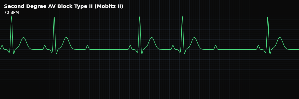 Second Degree AV Block Type II (Mobitz II) EKG rhythm strip showing Intermittent failure of AV conduction where beats drop suddenly without PR prolongation. The block is infranodal and carries a high risk of progression to complete heart block.