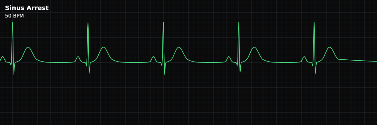 Sinus Arrest EKG rhythm strip showing A prolonged failure of the SA node to generate impulses, producing extended pauses (>3 seconds) that often require a subsidiary pacemaker escape beat to maintain cardiac output.