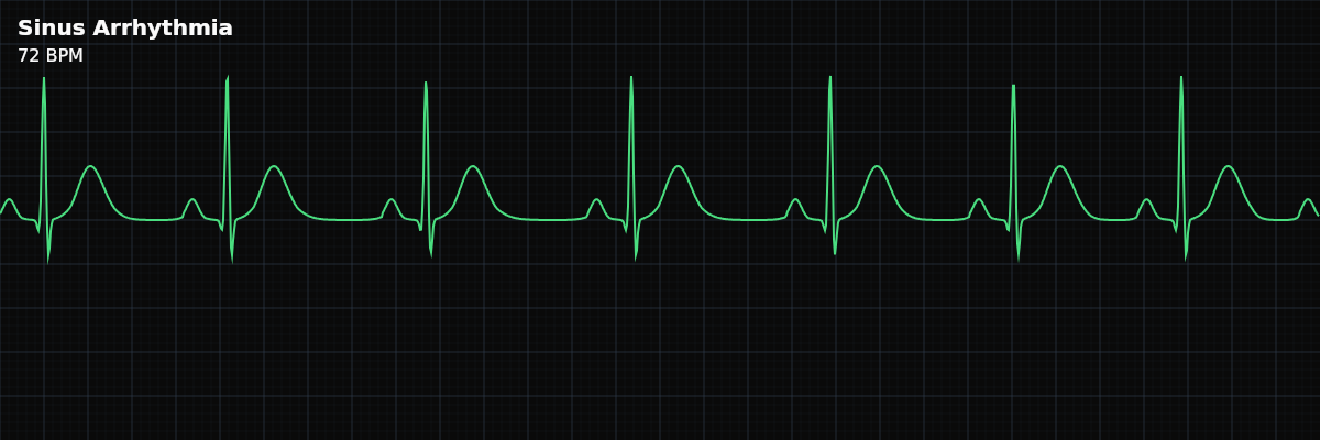 Sinus Arrhythmia EKG rhythm strip showing A normal sinus rhythm variant where the heart rate cyclically increases during inspiration and decreases during expiration, reflecting healthy autonomic modulation.
