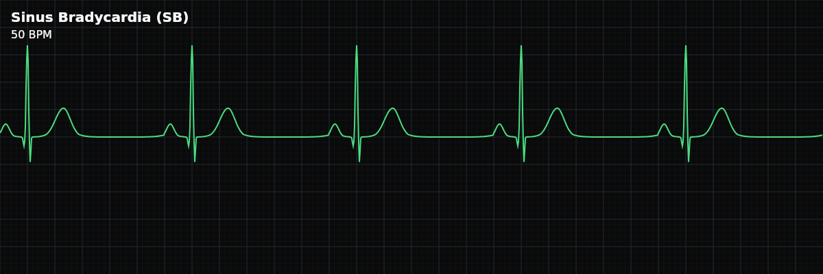 Sinus Bradycardia (SB) EKG rhythm strip showing A sinus rhythm with a rate below 60 bpm. The SA node fires slower than normal, but every other part of the conduction system works exactly as it should.