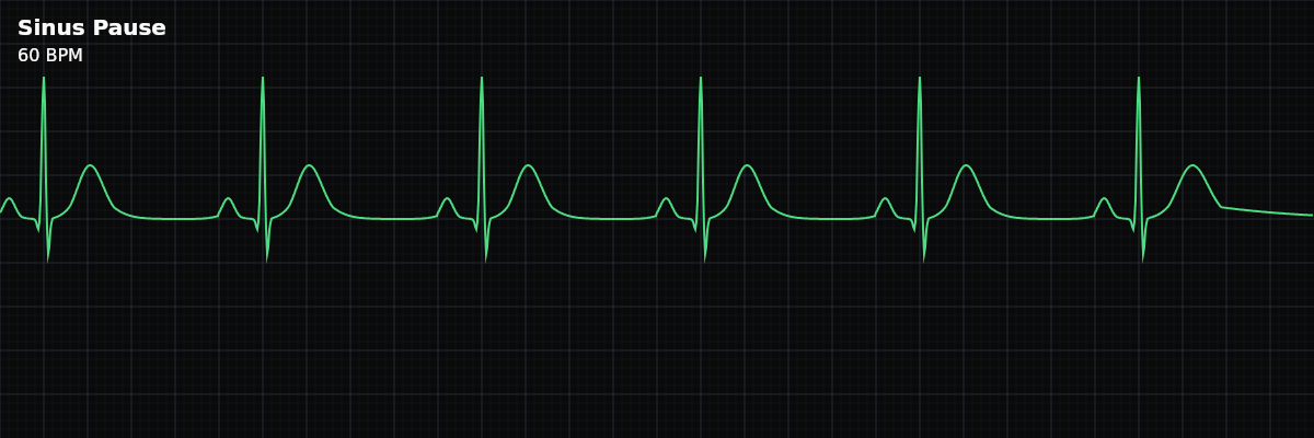 Sinus Pause EKG rhythm strip showing A transient failure of the SA node to fire, producing a pause in the cardiac rhythm typically lasting less than 3 seconds before normal sinus activity resumes.
