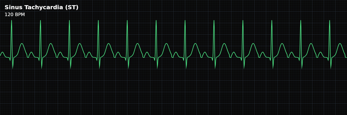 Sinus Tachycardia (ST) EKG rhythm strip showing A sinus rhythm with a rate above 100 bpm. The SA node fires faster than normal — usually because the body is asking it to — but conduction follows the same pathway as NSR.