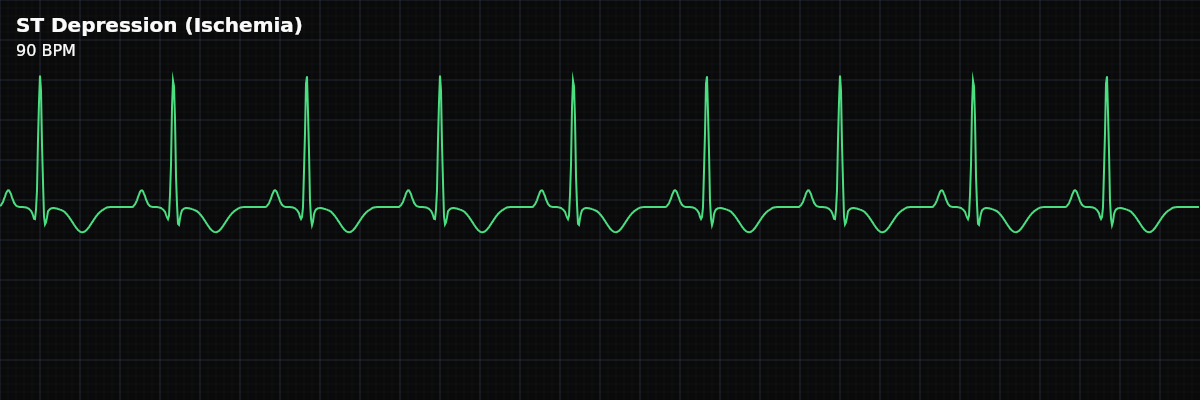 ST Depression (Ischemia) EKG rhythm strip showing ST segment depression below the baseline, indicating subendocardial ischemia — the inner layer of the heart wall is not receiving enough oxygen. This is an ST segment change, not a rhythm disturbance.