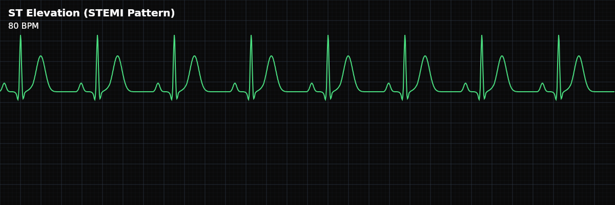 ST Elevation (STEMI Pattern) EKG rhythm strip showing Marked ST segment elevation above the baseline, indicating acute transmural myocardial injury — the full thickness of the heart wall is ischemic. This pattern represents a medical emergency requiring immediate reperfusion.