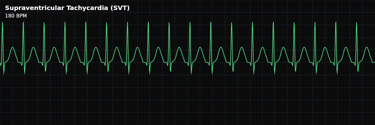 Supraventricular Tachycardia (SVT) EKG rhythm strip showing A rapid rhythm (150-250 bpm) originating above the ventricles, characterized by sudden onset and termination, where P-waves are typically absent or buried due to the extreme rate.