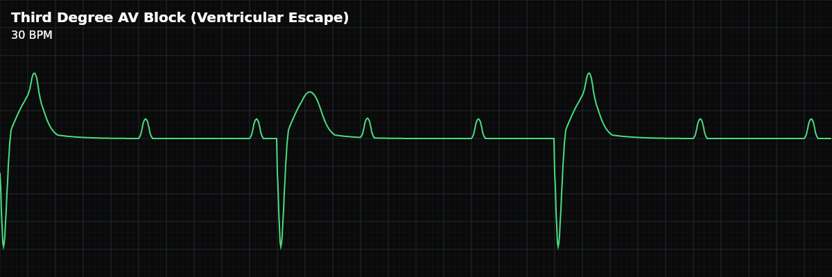 Third Degree AV Block (Ventricular Escape) EKG rhythm strip showing Complete heart block with a wide-QRS ventricular escape rhythm. The block is below the bundle bifurcation (infranodal), so the escape pacemaker originates in the ventricular conduction tissue. More urgent than junctional-escape complete heart block — the escape is unreliable and is a Class I indication for permanent pacing.
