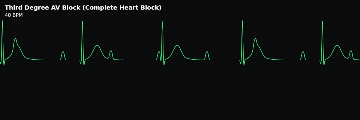Third Degree AV Block (Complete Heart Block) EKG rhythm strip showing Complete failure of AV conduction — no atrial impulses reach the ventricles. The atria and ventricles beat independently (AV dissociation), and the ventricles are sustained only by an escape rhythm.