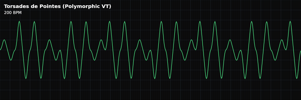 Torsades de Pointes (Polymorphic VT) EKG rhythm strip showing A distinctive polymorphic ventricular tachycardia where the QRS complexes appear to twist around the baseline — amplitude waxes and wanes as polarity gradually shifts. Associated with prolonged QT interval.