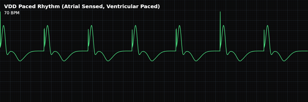 VDD Paced Rhythm (Atrial Sensed, Ventricular Paced) EKG rhythm strip showing A pacing mode that senses native atrial activity and paces the ventricle after a programmed AV delay. Maintains AV synchrony using the patient's own SA node — no atrial spike on the strip.
