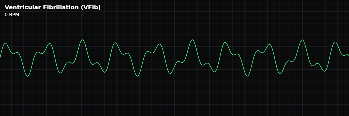 Ventricular Fibrillation (VFib) EKG rhythm strip showing A chaotic, life-threatening cardiac arrest rhythm where the ventricles quiver without any effective contraction, resulting in zero cardiac output.