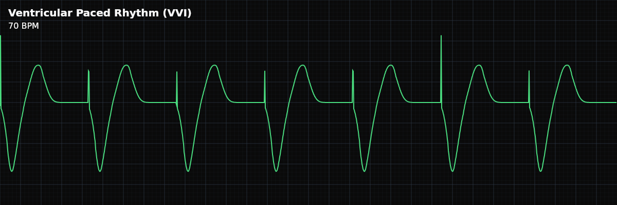 Ventricular Paced Rhythm (VVI) EKG rhythm strip showing A pacemaker directly stimulates the ventricles, producing a wide QRS with LBBB morphology. The most recognizable paced rhythm — a spike immediately before each wide QRS complex.
