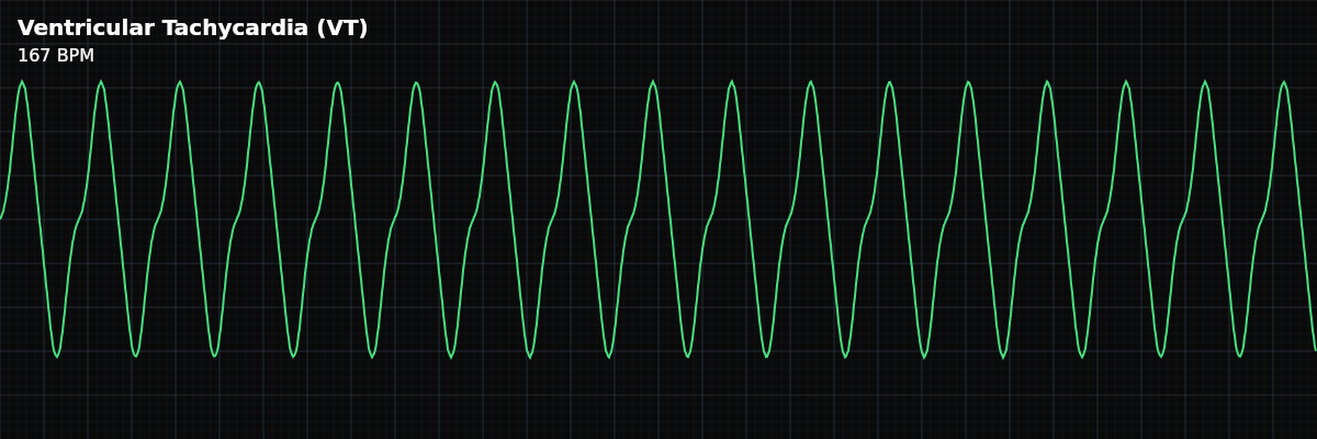 Ventricular Tachycardia (VT) EKG rhythm strip showing A life-threatening wide-complex tachycardia originating in the ventricles. Can be monomorphic or polymorphic.