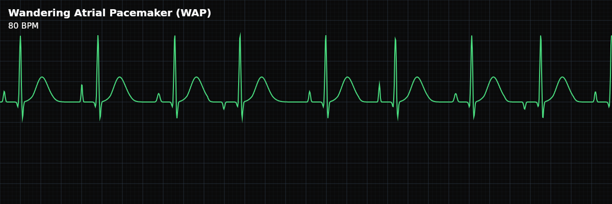 Wandering Atrial Pacemaker (WAP) EKG rhythm strip showing An irregular rhythm with at least 3 distinct P-wave morphologies at a rate below 100 BPM, indicating the dominant pacemaker is shifting between the SA node and other atrial foci.