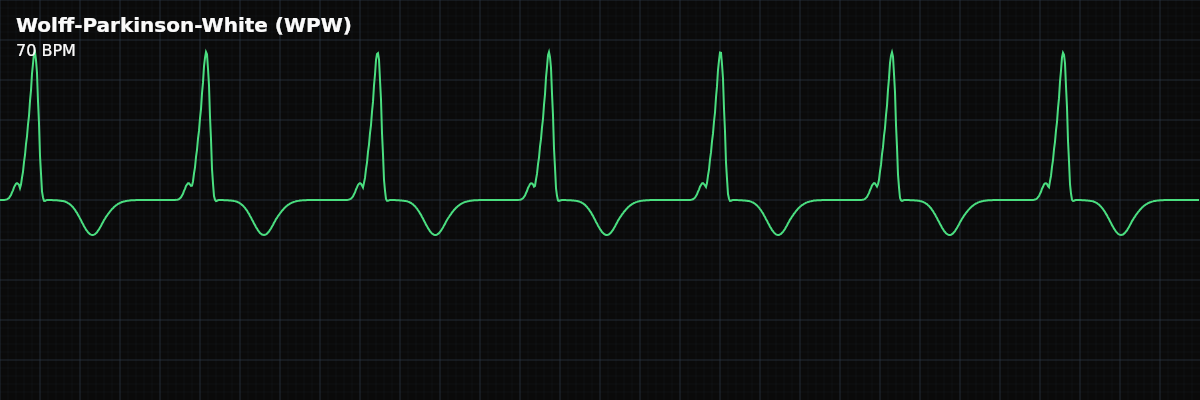 Wolff-Parkinson-White (WPW) EKG rhythm strip showing A pre-excitation syndrome where an accessory pathway (bundle of Kent) bypasses the AV node, producing the classic triad: short PR interval, delta wave (slurred QRS upstroke), and widened QRS complex.